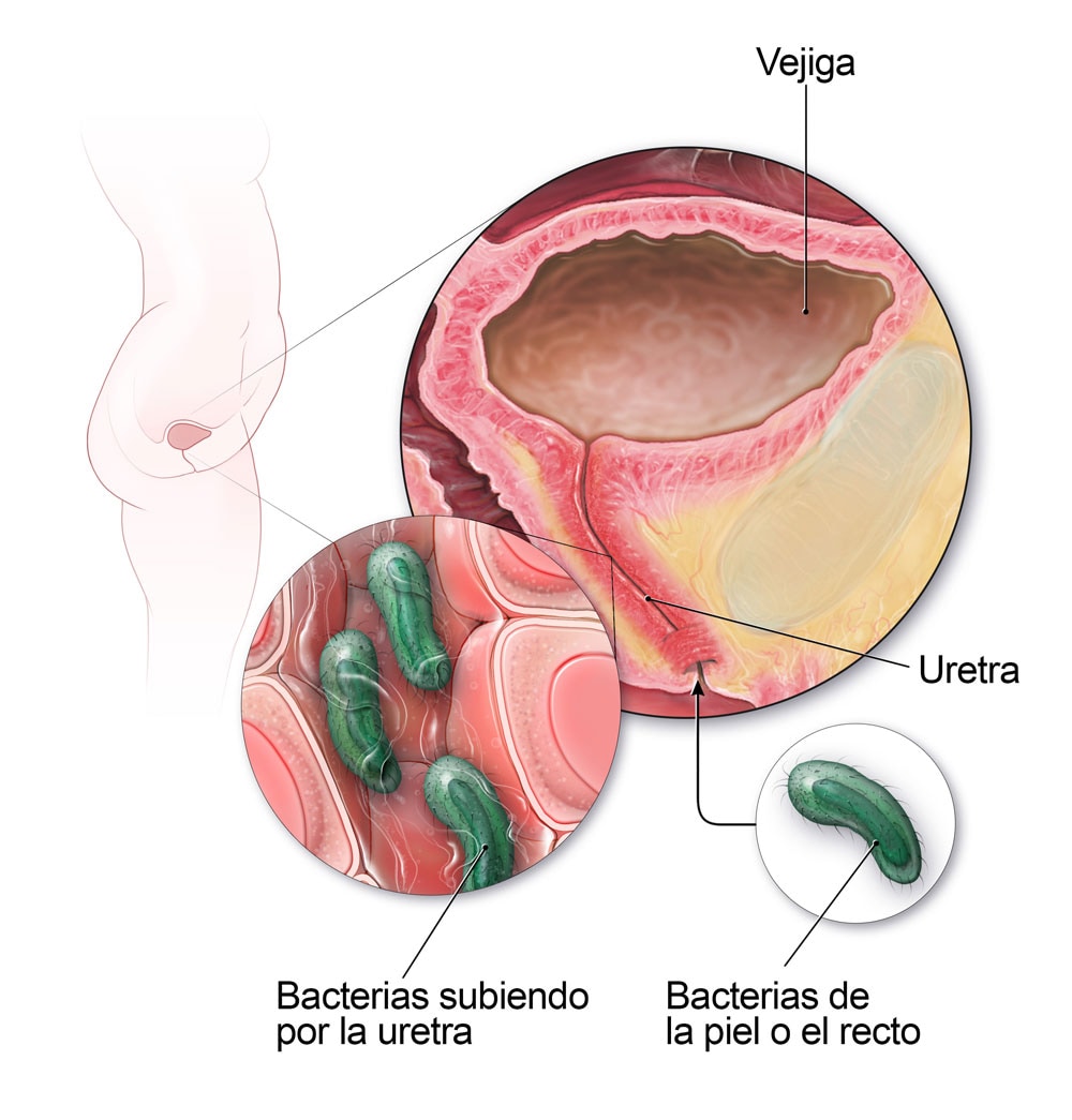 Diagrama de vías urinarias femeninas infectadas por bacterias.