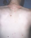 Vaccinated child with light skin presented with the characteristic pancorporeal varicella, or chickenpox lesions. Source: Varicella Active Surveillance Project.