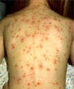 Adolescent female with varicella lesions in various stages. Source: http://www.vaccineinformation.org/photos/variaap002.jpg. Copyright: American Academy of Pediatrics