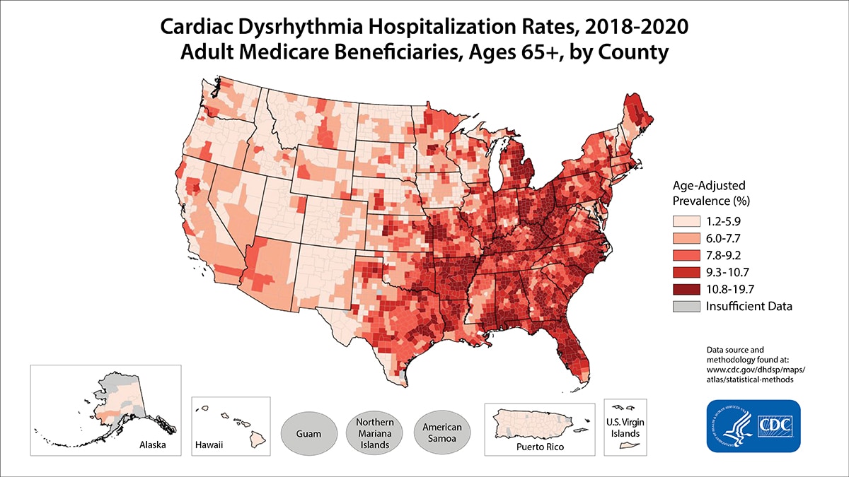 Cardiac Dysrhythmia Hospitalization Rates for 2018 through 2020 for adults receiving Medicare Beneficiaries Aged 65 Years and Older by County. The map shows that concentrations of counties with the highest Cardiac Dysrhythmia Hospitalization Rates - meaning the top quintile - are located primarily in Florida, Georgia, Alabama, Arkansas, Kentucky North Carolina, West Virginia, Ohio, and Michigan. Pockets of high-rate counties also were found in Texas, Louisiana, Oklahoma, Nebraska, Missouri, Illinois, Tennessee, South Carolina, Indiana, Virginia, Pennsylvania, New Jersey, New York, Vermont, and Maine.