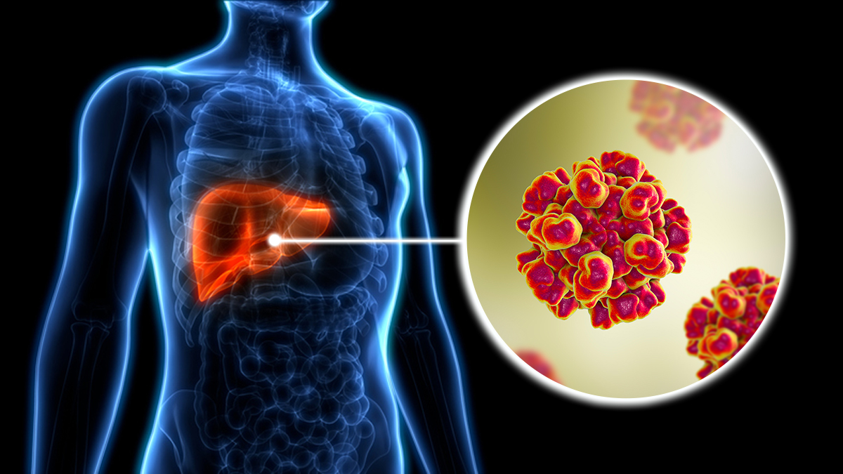 Artist rendition of the hepatitis E virus on the body