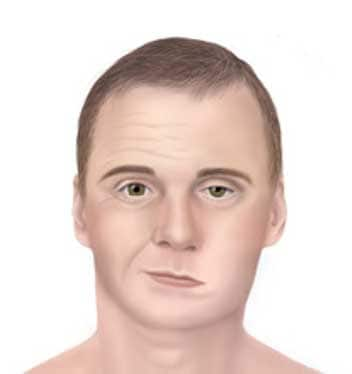 Man displaying symptoms of facial palsy