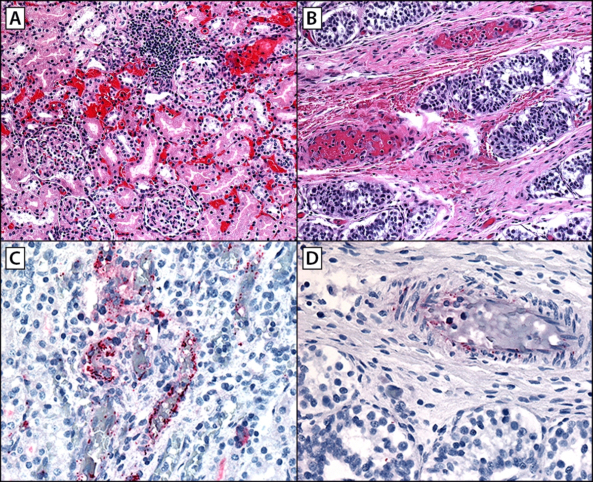 Figure is a series of four images illustrating the histopathologic findings in a fatal pediatric case of Rocky Mountain spotted fever showing extensive microhemorrhages, vascular inflammation, and endothelial injury in multiple organs including kidneys (A), testes (B), and rickettsial antigens identified by immunohistochemistry distributed predominately in endothelial cells of capillaries, arterioles, and venules in the vasa recta in the kidneys (C), and in interstitial areas in testes (D) in California in August 2023.