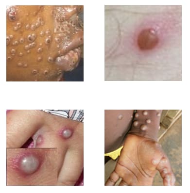 Four photos of mpox rashes on different parts of the body