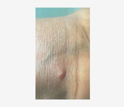 Photo of a small raised bump on a dark-skinned person's inner wrist