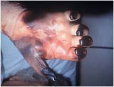 Digital necrosis in hand with untreated Rocky Mountain spotted fever