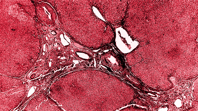 Schistosomiasis in liver tissue