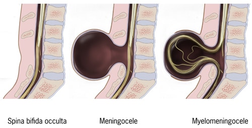 Shows the three most common types of spina bifida On the left is spina bifida occulta, in the middle is meningocele, and on the right is myelomeningocele.