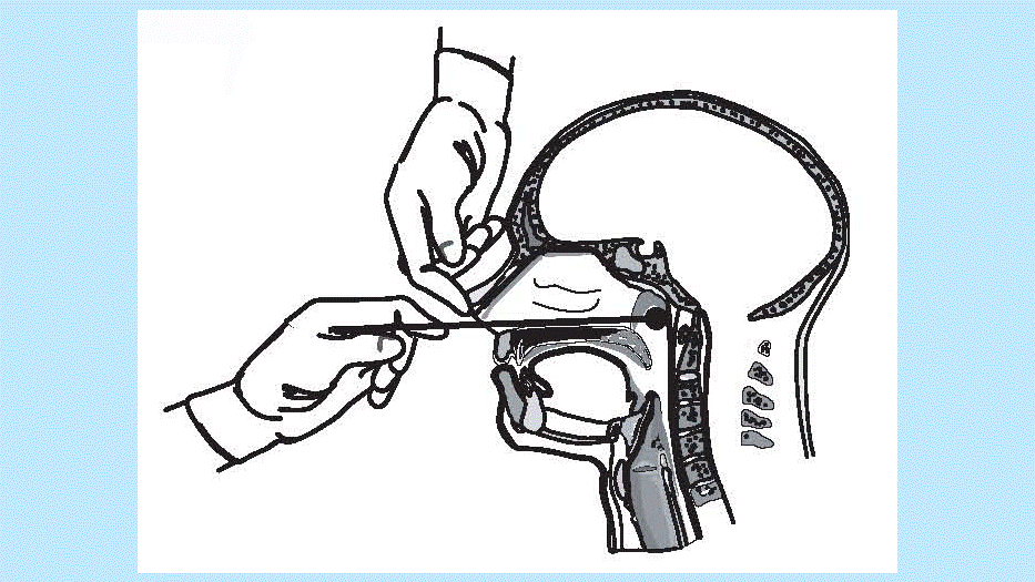 Figure 1: Proper technique for obtaining a nasopharyngeal specimen for isolation of B. pertussis