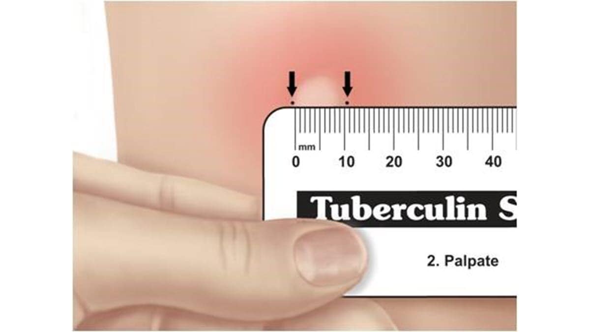 A health care provider reads a TB skin test result